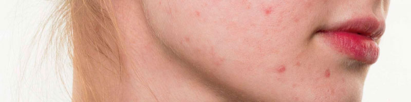 acne